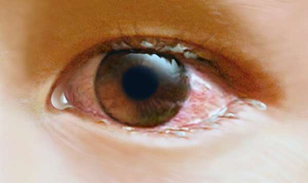 фото больного глаза конъюнктивита у ребенка